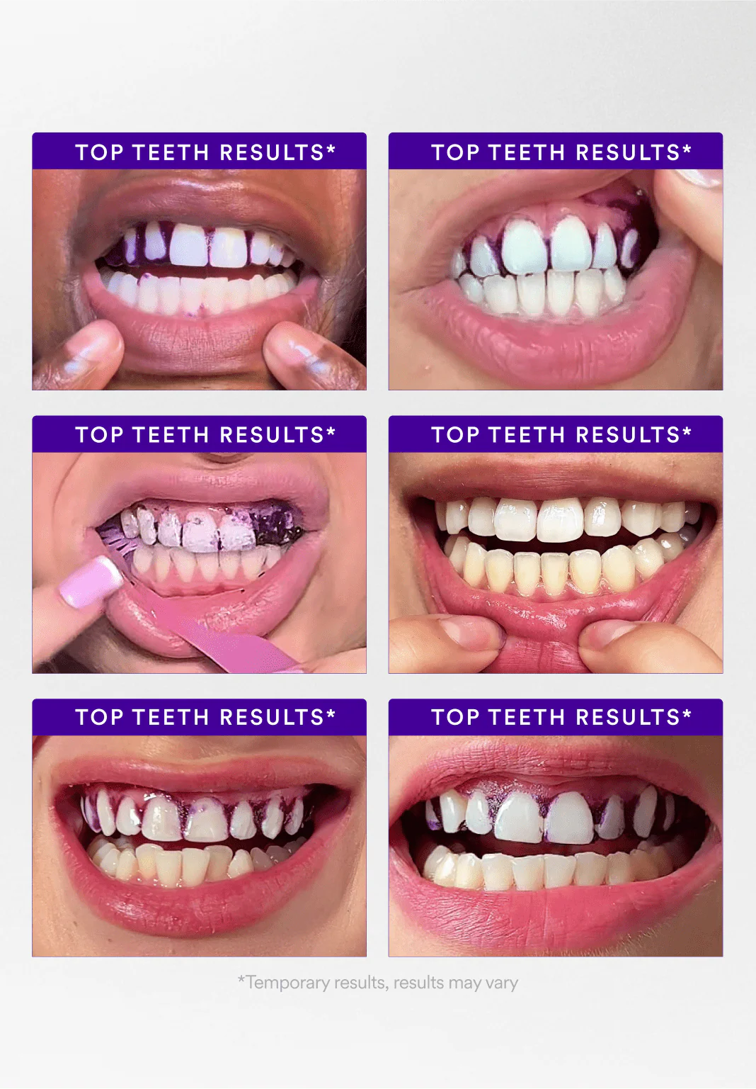 👨‍⚕️Purple Teeth Whitening Strips:Revolutionary Dissolving Diamond Series Technology with Hydroxyapatite 💎